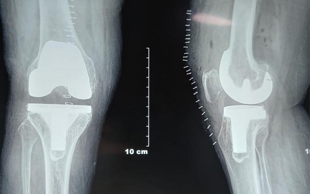 Knee Replacement Surgeon in Baner