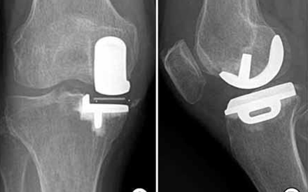Partial Knee Replacement Surgery in Baner