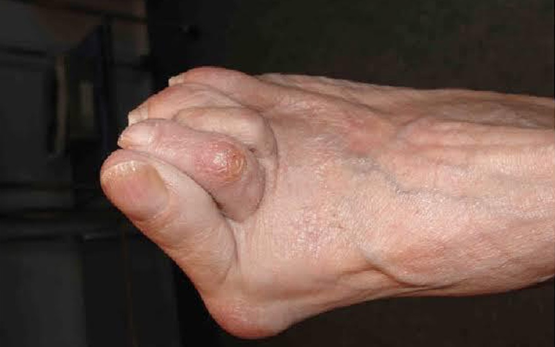 Toes Deformities Correction in Baner