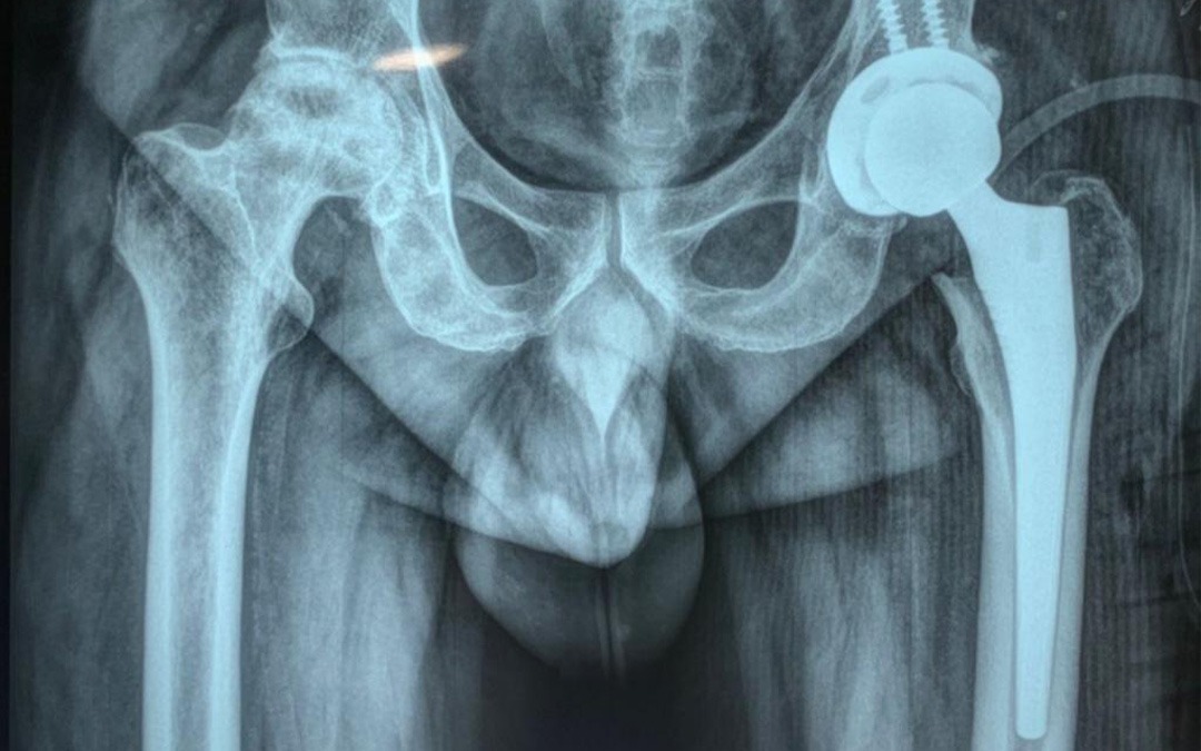 Hip Replacement Surgeon in Baner