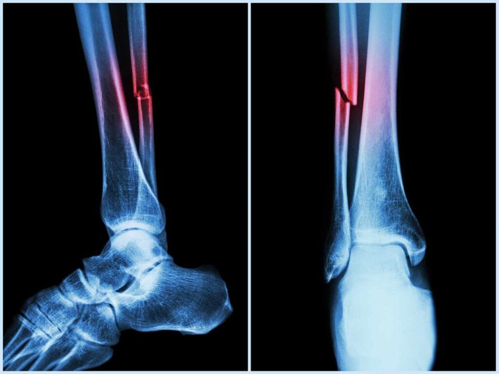 Ankle fracture clinic in Baner