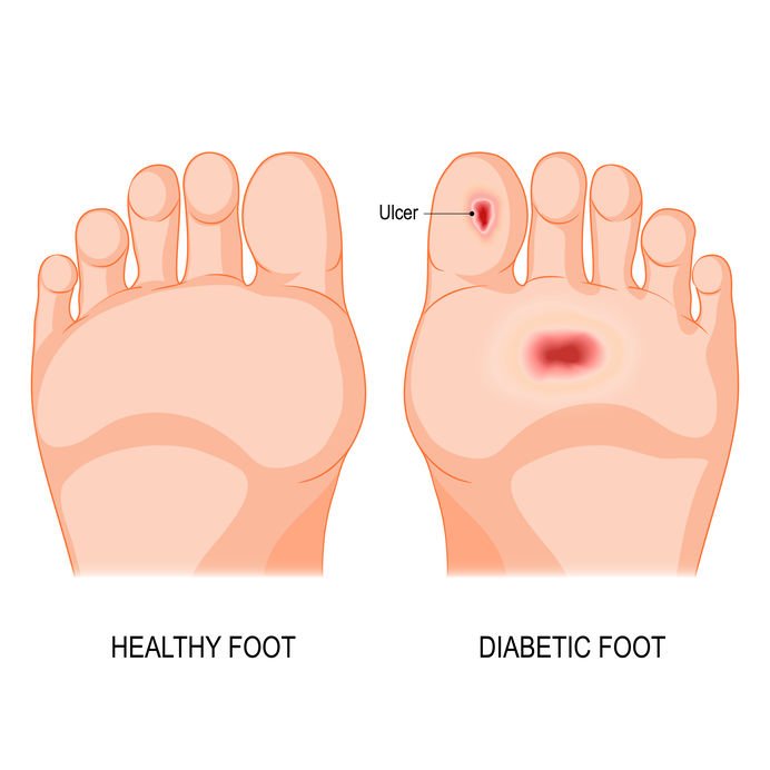 Diabetic Foot Management in Balewadi