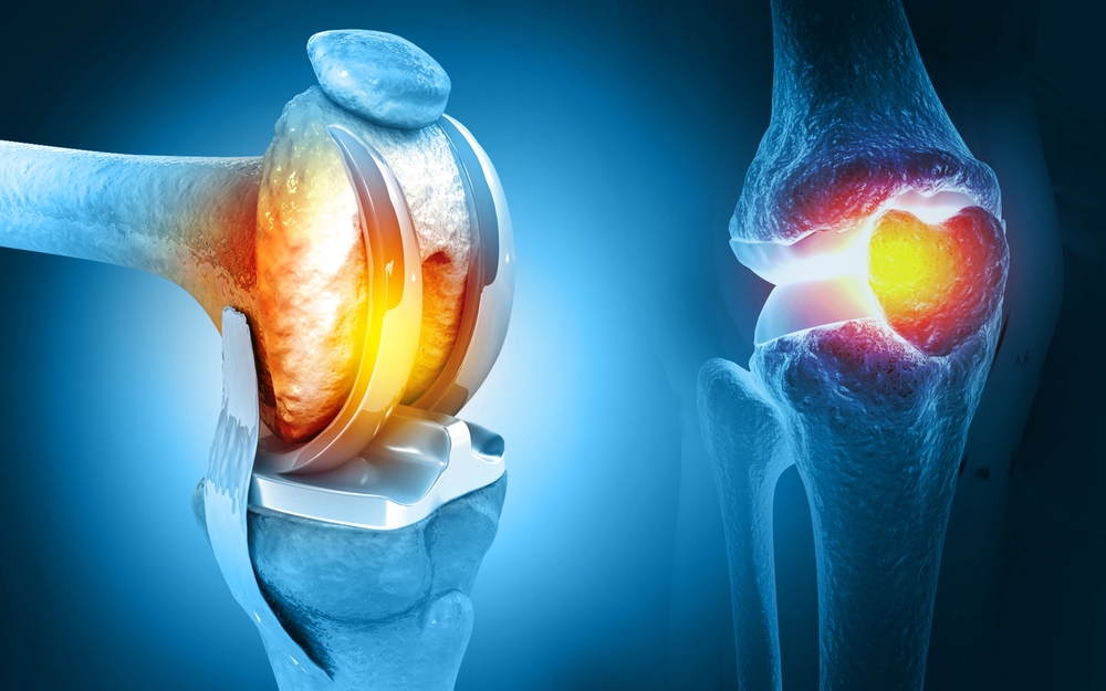 Knee Replacement Surgeon in Aundh