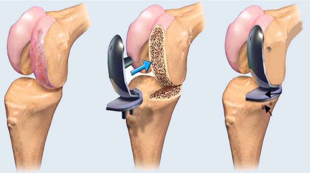 Knee Replacement Surgeon in Balewadi