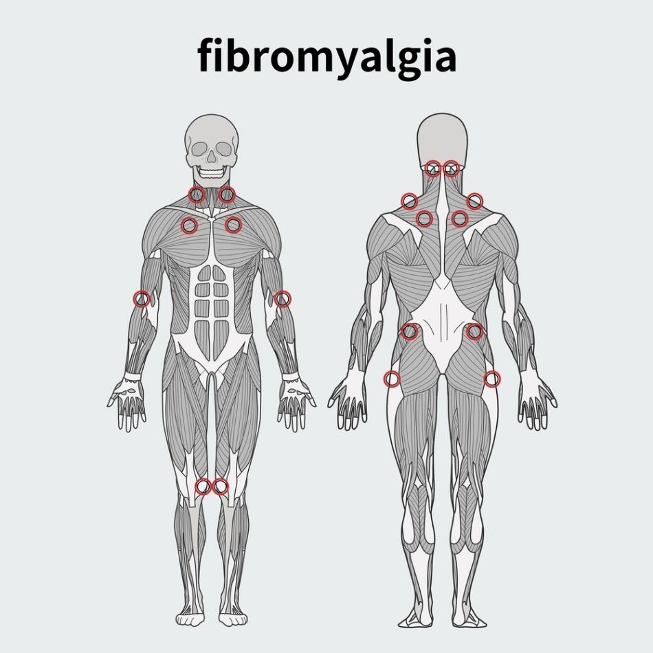 Fibromyalgia 101: What You Need to Know About This Chronic Pain Condition