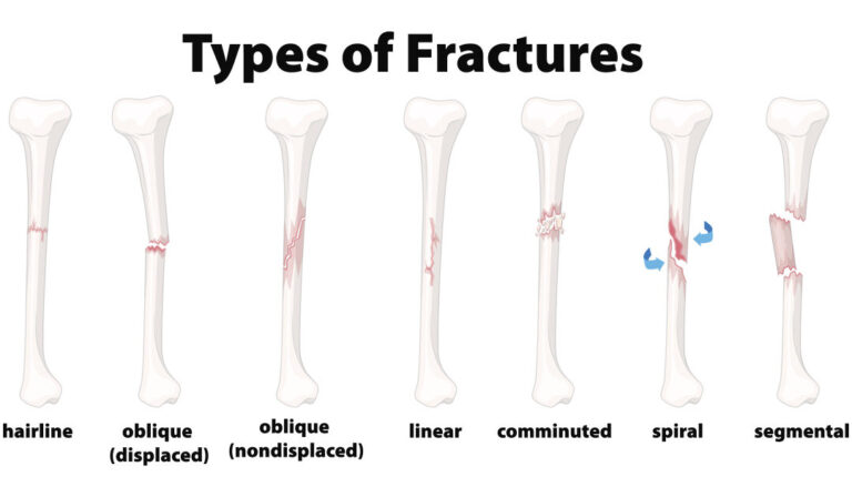 Types of fractures