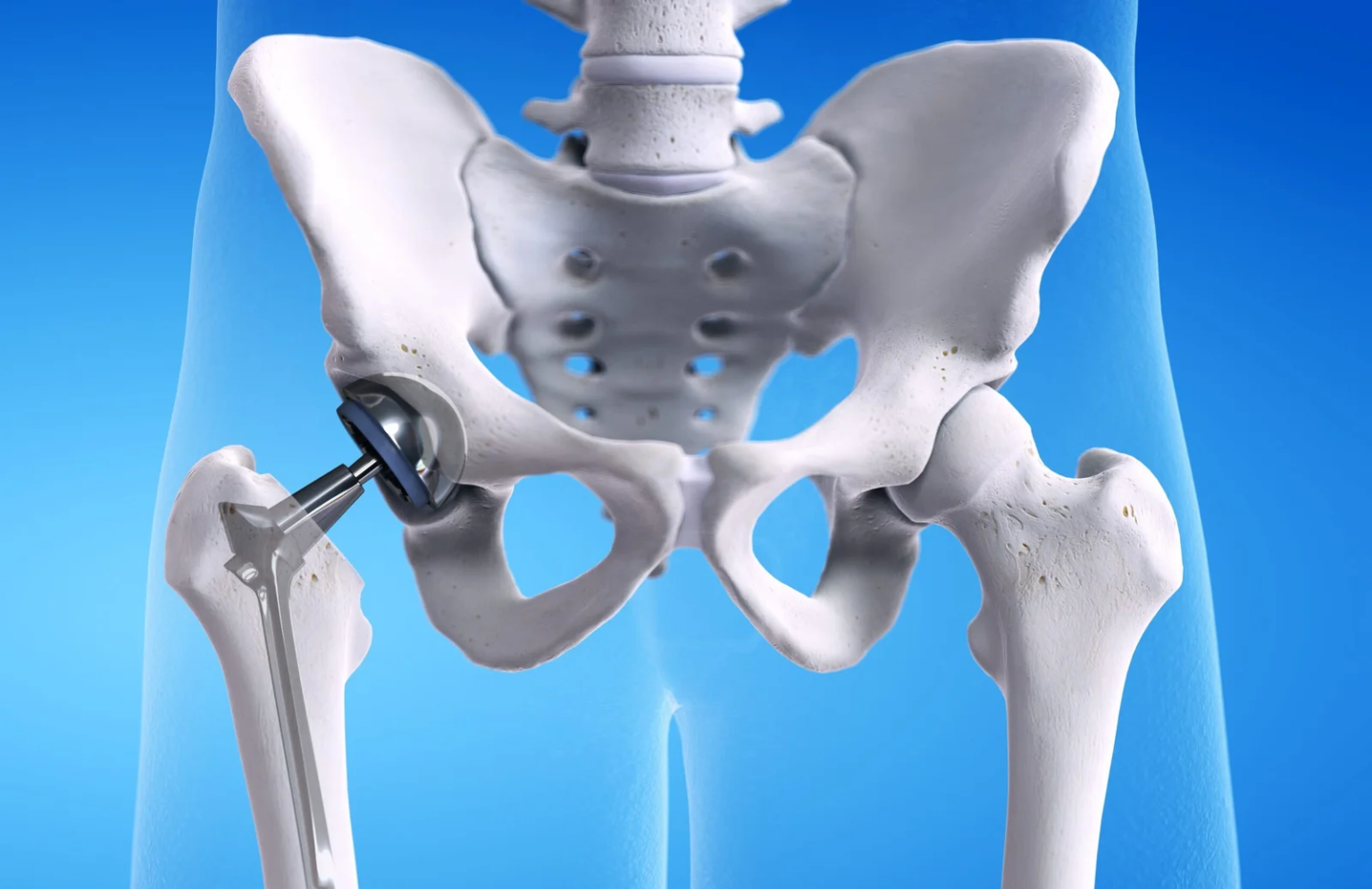 Restore Mobility and Relieve Pain with Expert Hip Replacement Surgery