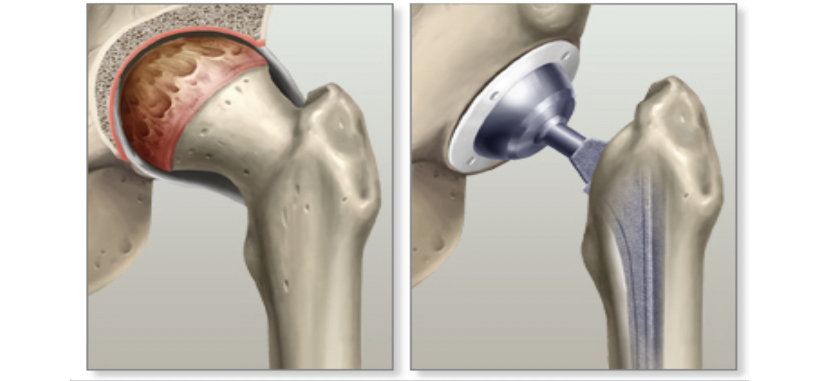 Recovery Tips After Hip Replacement Surgery